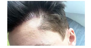 hair transplant procedure